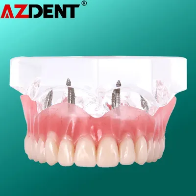 Prothèse dentaire modèle de dents mandibulaire interne amovible inférieur avec Implant pour