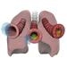 Lungs and bronchioles depicting asthma stages of inflammation and mucus Poster Print by Photon Illustration/Stocktrek Im