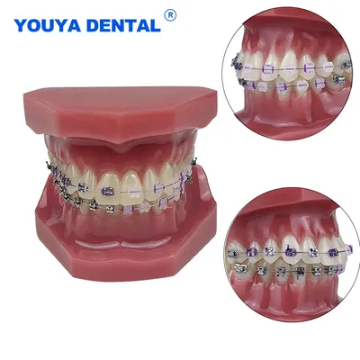 Modèle de dents en résine orthodontique avec supports en métal et en céramique attaches de