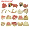 YOUYA 1PCS Dental Modell Zähne Implantat Praxis Modell Zahn Zahn Implantat Modell Ausbildung Display