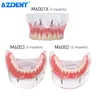 AZDENT Dental Implantat Zähne Modell Abnehmbare Innen Kiefer Demo Overdenture Mit Implantate Oberen