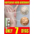 Varicose vein ointment quickly repair varicose veins and vasculitis