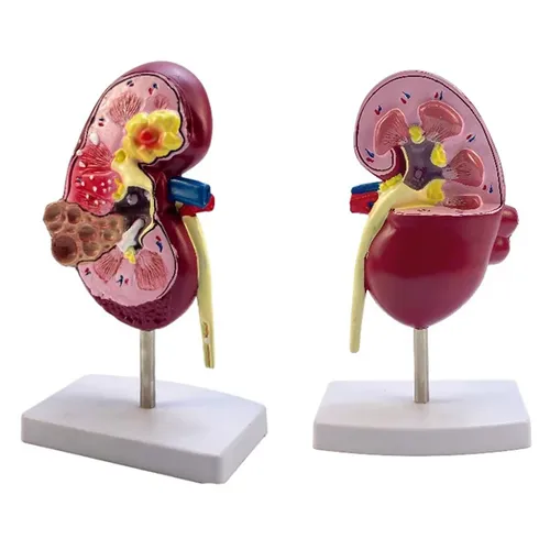 1 Stück lebensgroße Nieren pathologien Modell Anatomie des menschlichen Körpers Replik der