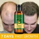 Ginger Hair Growth olio essenziale Anti-perdita siero per la ricrescita dei capelli crescita rapida