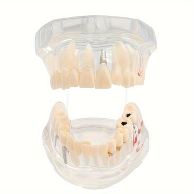 Dental Teaching Model Dental Removable Dental Restoration Model Pathological Tooth Model Movable Tooth Model Dental Implant Model