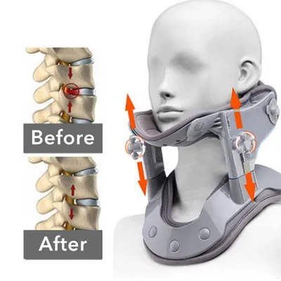 Medical Neck traction device Inflatable Cervical Collar Correction kit Neck Retractor Cervical