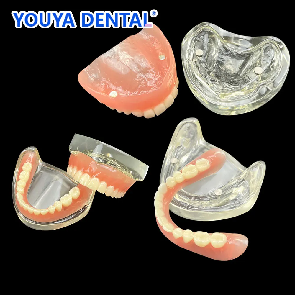 2 Implantat-Modelle für den oberen und unteren Backen, zahnmedizinisches Modell, Zähne, abnehmbare Brücke, Implantat-Restaurierungsmodelle, Restaurierung, Lehrstudie Image