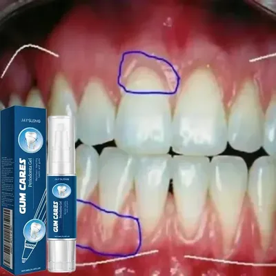 Damaged Gum Repair Care Gel Relieve Sore Gums Allergy Deep Cleaning Teeth Stains Tartar Serum Dental Caries Toothpaste