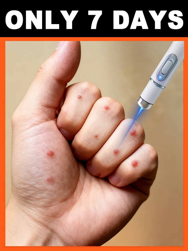 ᴸᵃˢᵉʳ ᵖᵉⁿ ᵈᵉᵉᵖ ʳᵉᵐᵒᵛᵉˢ ʷᵃʳᵗˢ⸴ ʳᵉᵈᵘᶜᵉˢ the root cause and reduces recurrence Image