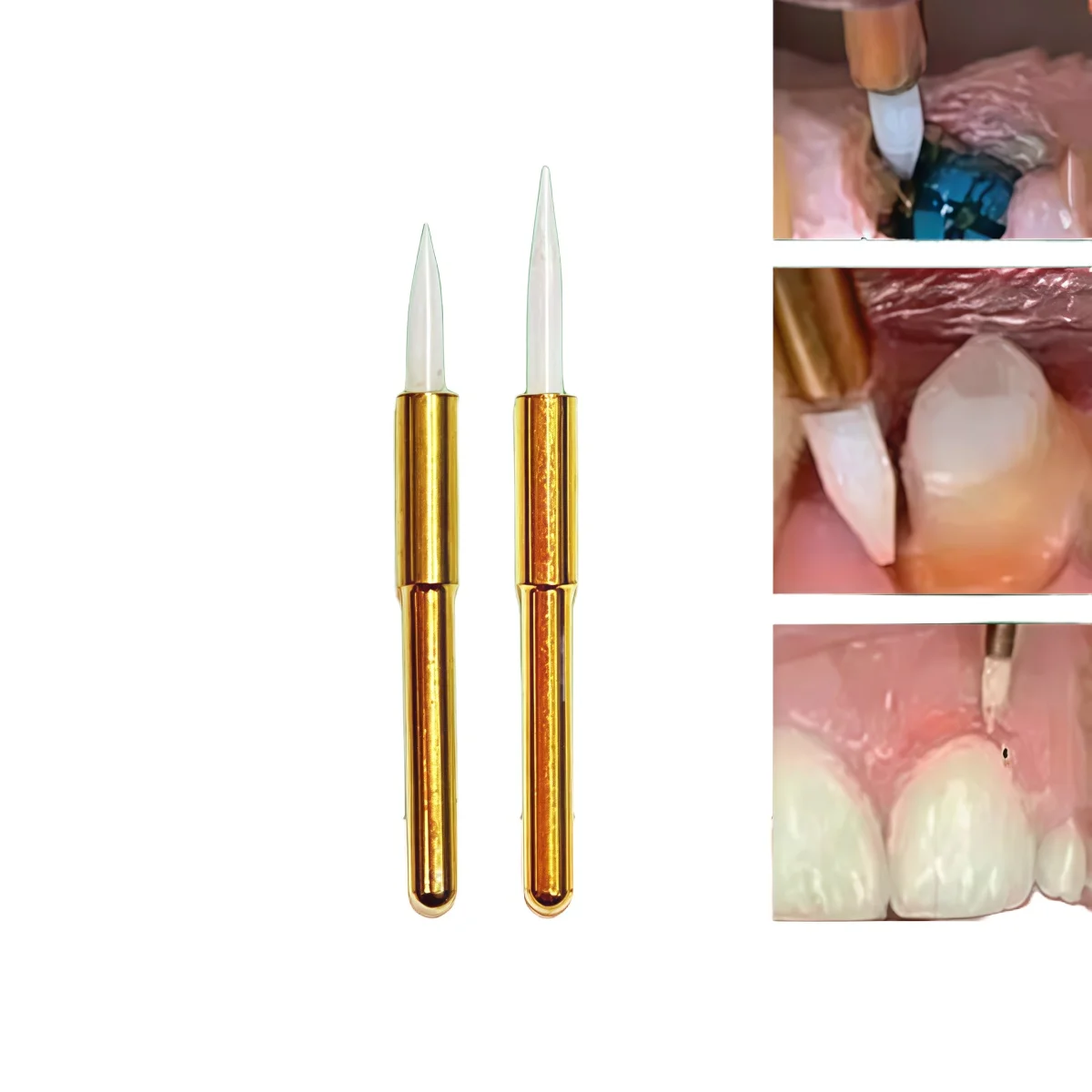 1/2 stücke Dental Bur Zahnmedizin Keramik Weiche Tissue Trimmer für Zahnfleisch Rückzug und Hyperplastic Zahnfleisch Schneiden Dental Implantat spitze Image