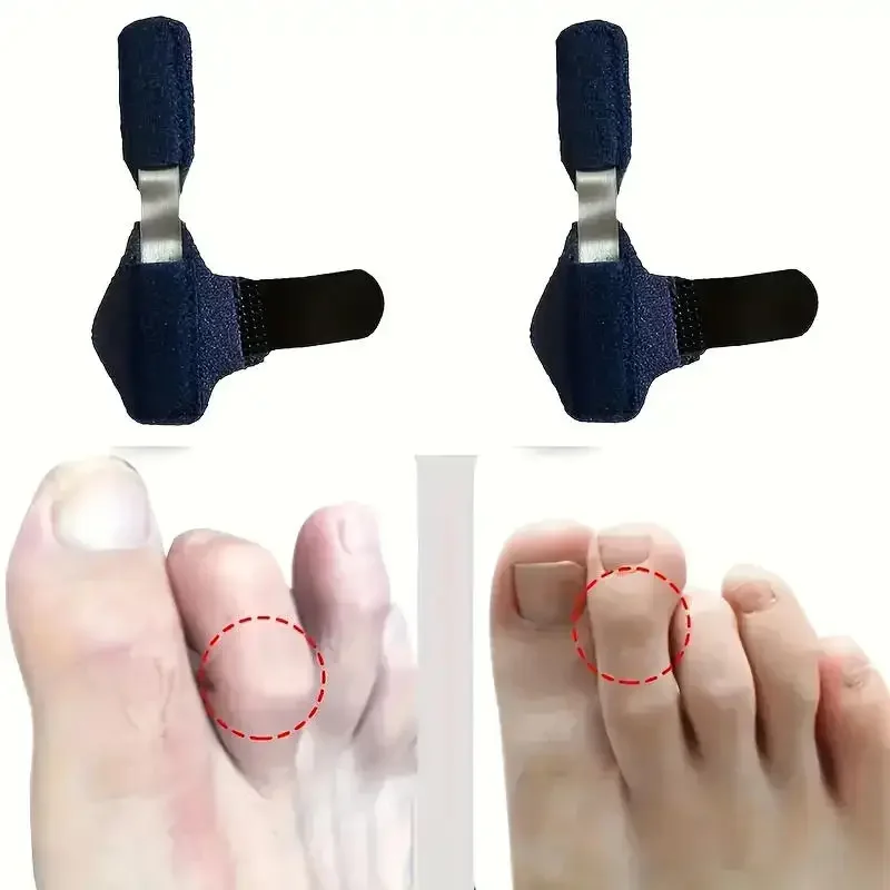 Zehenschiene-Glätteisen für Hammerzehen-Korrektor, krumme Zehen, Klaue, Zehenstabilisator, Stützbandage, Schmerzlinderung, Kinder und Erwachsene Image